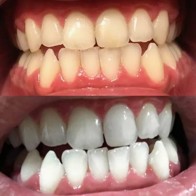 Denti bianchi dopo lo sbiancamento con un kit e un gel sbiancante per denti.