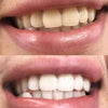 Immagini prima e dopo il set di sbiancamento dentale PAP+ di Diamond Smile