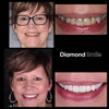 Esperienza di sbiancamento dentale Diamond Smile - Donna con foto prima e dopo dei denti bianchi