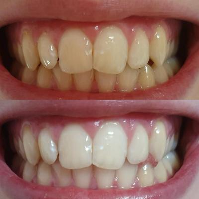 Denti bianchi e gialli. Denti bianchi dopo lo sbiancamento dei denti con il gel sbiancante. Sbiancamento dei denti con lo sbiancamento dei denti.