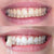 Denti bianchi dopo lo sbiancamento con un kit e un gel sbiancante per denti.