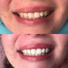 Sbiancamento dei denti a casa - Set per sbiancamento