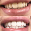 Denti bianchi e brillanti grazie allo sbiancamento dentale Diamond