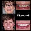 Risultato Schiuma sbiancante Diamond Smile per la correzione del colore dei denti - Prima foto Dopo foto di denti bianchi