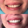 Risultato con lo spazzolino sonico sbiancante Power LED di Diamond Smile con foto prima e dopo lo sbiancamento dentale