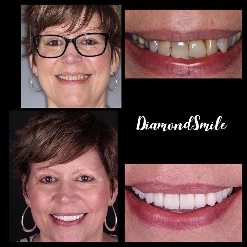 Donna anziana Prima e dopo le immagini del gel sbiancante PAP+ di Diamond Smile