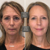 MicroLift Shot