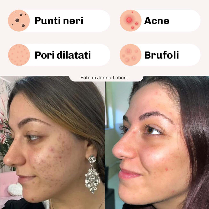 Trattamento punti neri Diamond con effetto immediato visibile