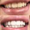 PAP+ Kit Sbiancamento Denti per sbiancare i denti