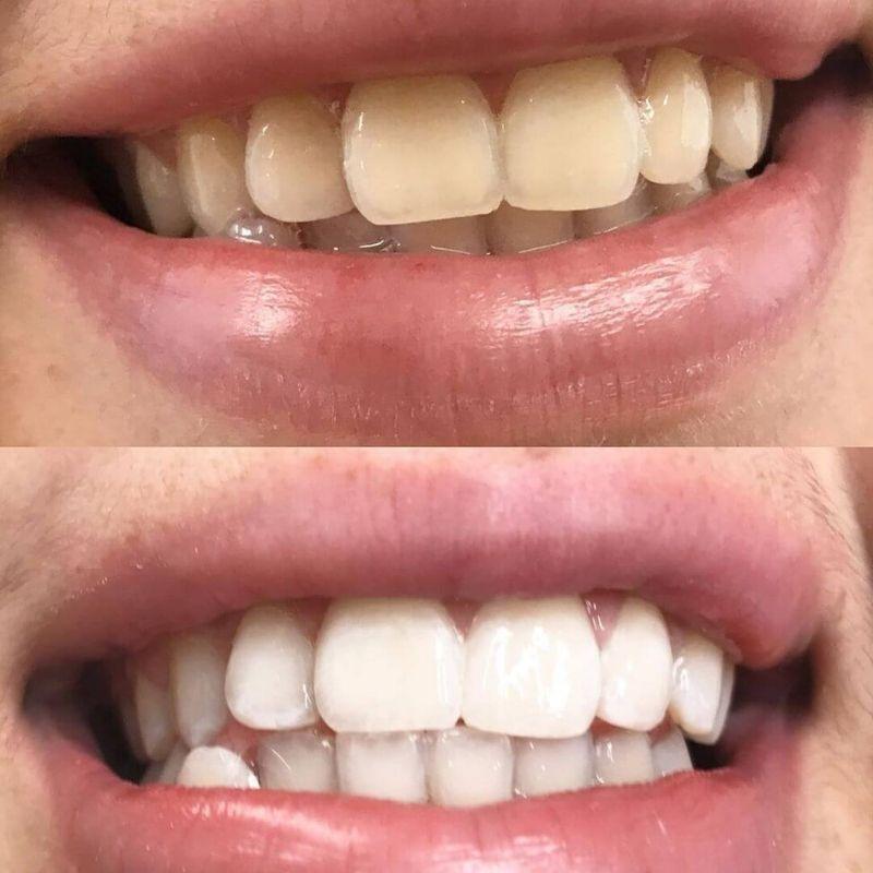 Foto prima e dopo il gel sbiancante PAP+ di Diamond Smile