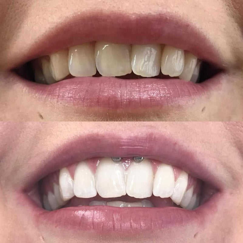 Whitening Collutorio iD+