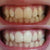 Denti bianchi e gialli. Denti bianchi dopo lo sbiancamento dei denti con il gel sbiancante. Sbiancamento dei denti con lo sbiancamento dei denti.