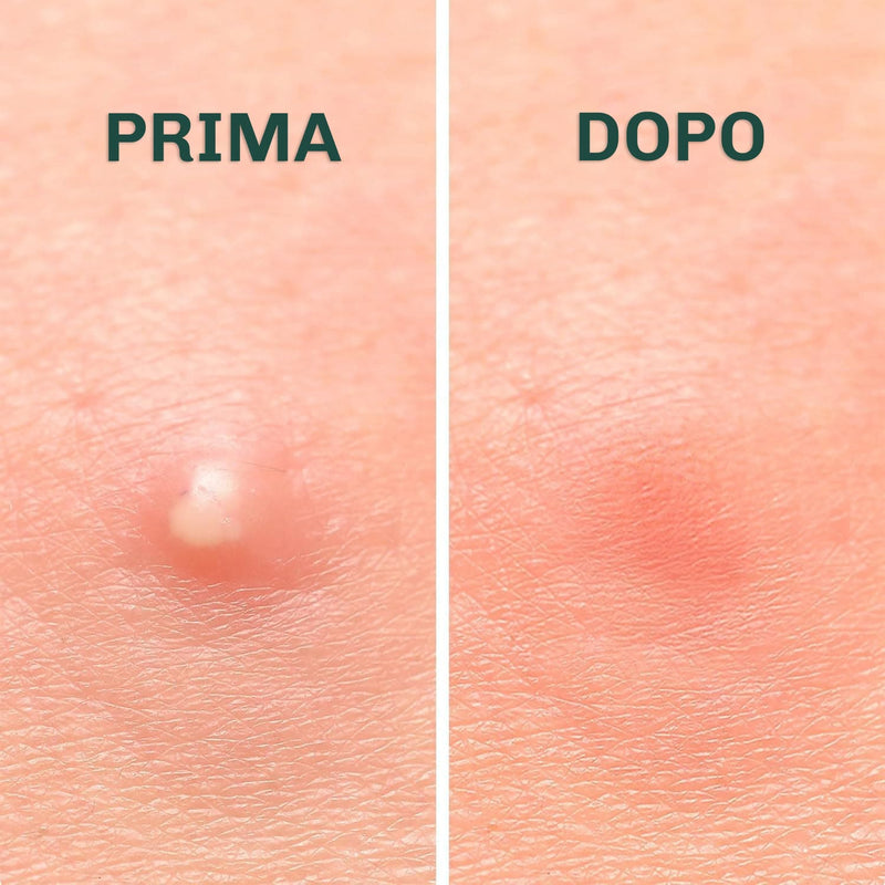 Cerotti Diamond per trattamento brufoli durante la notte