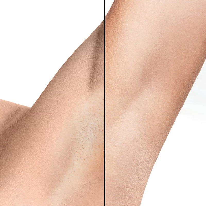 Dispositivo luce pulsata Diamond per riduzione della ricrescita dei peli