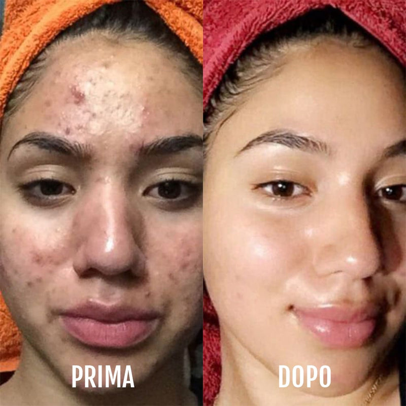 Fototerapia acne viso Diamond delicata e non invasiva