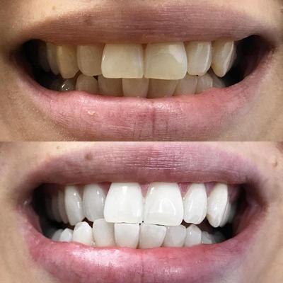 Sbiancamento dei denti per denti bianchi. La foto mostra un'immagine prima e dopo i denti dopo lo sbiancamento.