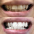 Sbiancamento dei denti per denti bianchi. La foto mostra un'immagine prima e dopo i denti dopo lo sbiancamento.