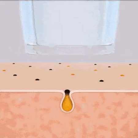 Aspiratore punti neri SkinClear Diamond per pulizia profonda dei pori