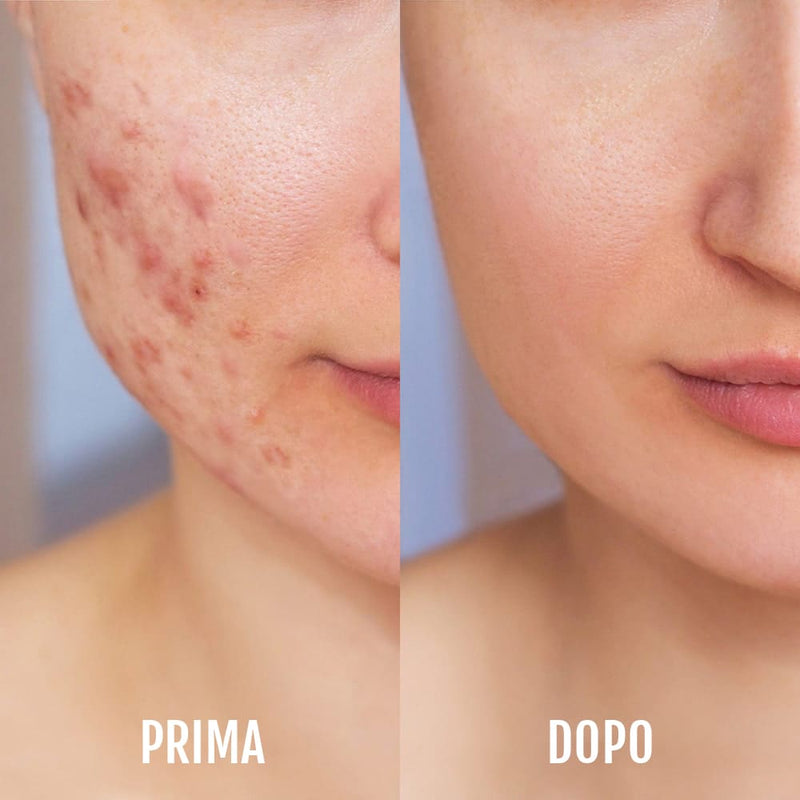 Trattamento LED Diamond per impurita cutanee