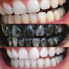 Sbiancamento cosmetico dei denti con carbone attivo