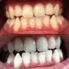 Esperienza con lo sbiancamento dei denti. Sbiancamento dentale cosmetico e sbiancamento
