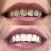 Esperienza di sbiancamento dei denti - Bocca con foto prima Dopo foto di denti bianchi