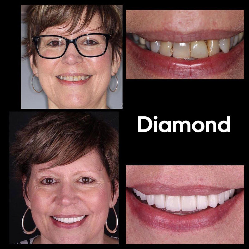 Esperienza di sbiancamento dentale Diamond Smile - Donna con foto prima e dopo dei denti bianchi
