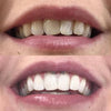Esperienza di sbiancamento dei denti - Bocca con foto prima Dopo foto di denti bianchi