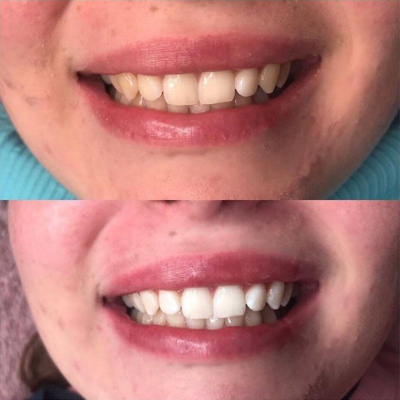 Esperienza di sbiancamento dentale Diamond Smile con schiuma correttiva del colore viola - bocca con foto prima e dopo dei denti bianchi