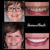Sbiancamento dei denti - Set per lo sbiancamento dei denti di Diamond Smile